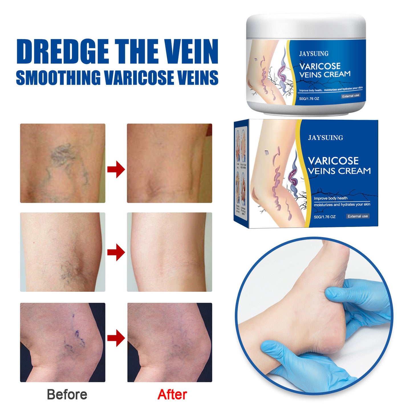 Leg Vein Repair Cream
